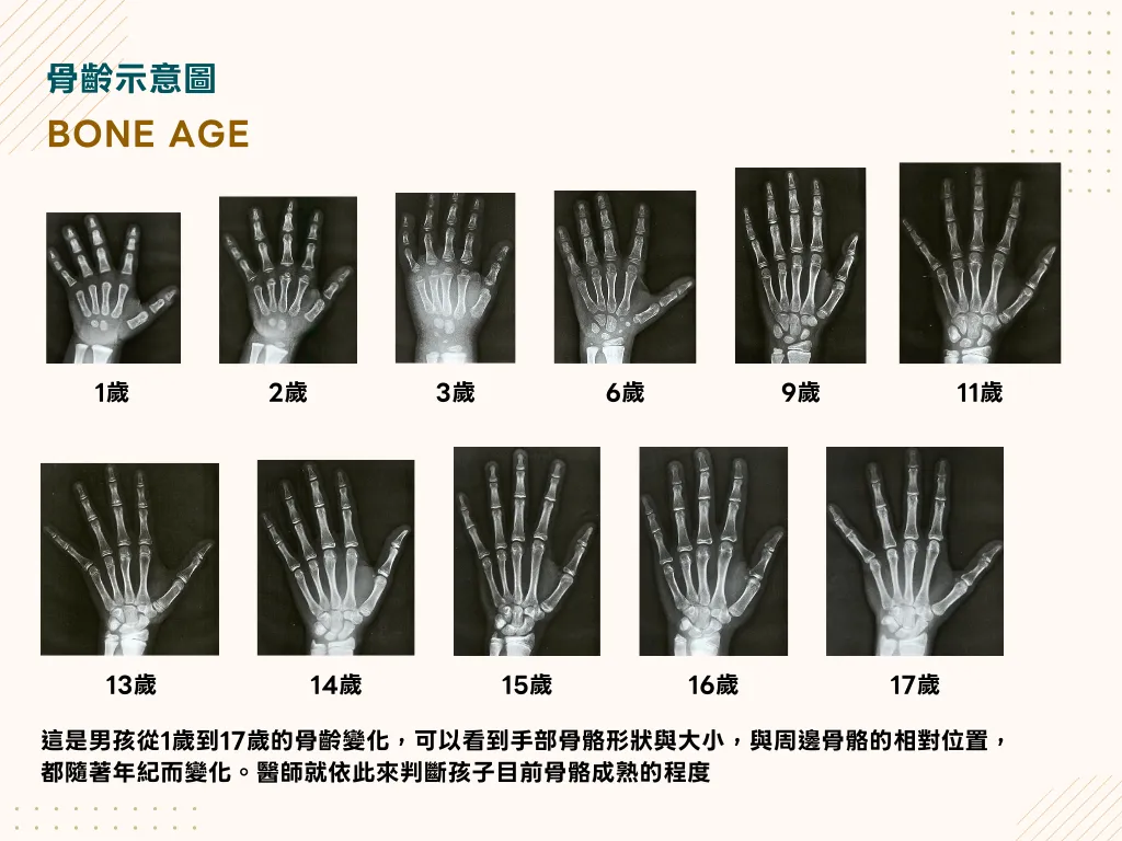 藉由骨骼成熟的程度與周邊骨骼的相對位置,醫師可判斷目前孩子骨骼成熟的程度。