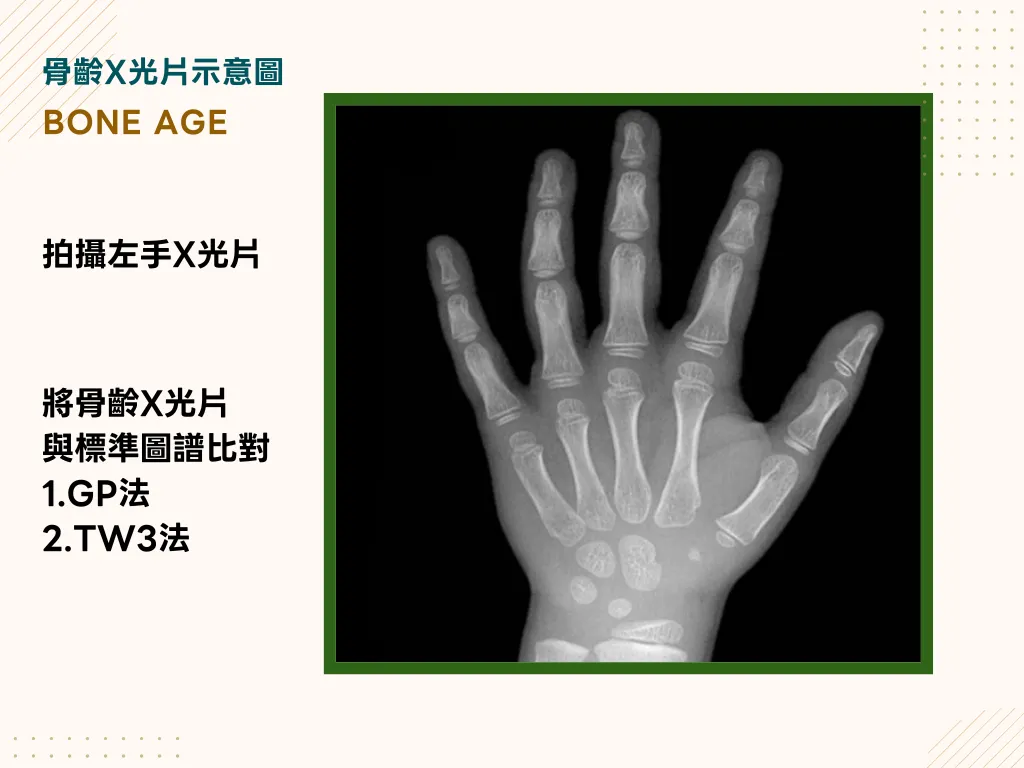 兒童骨齡X光片示意圖,顯示手腕骨骼發育程度