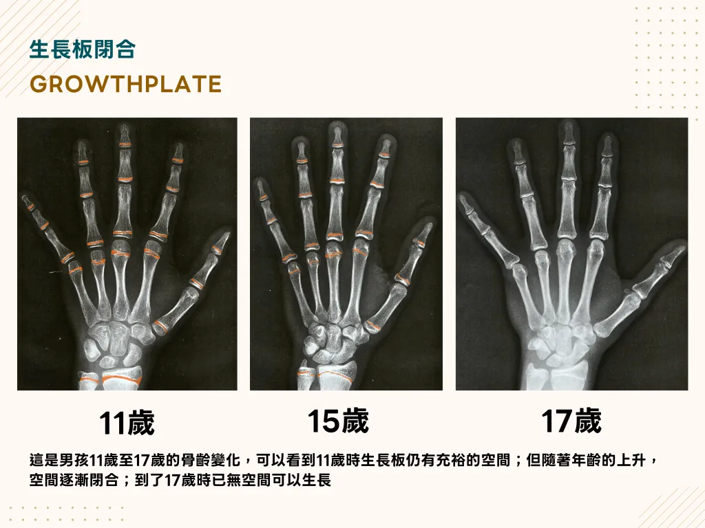 男孩手部X光從11歲到17歲的骨齡變化，顯示生長板逐漸閉合的過程